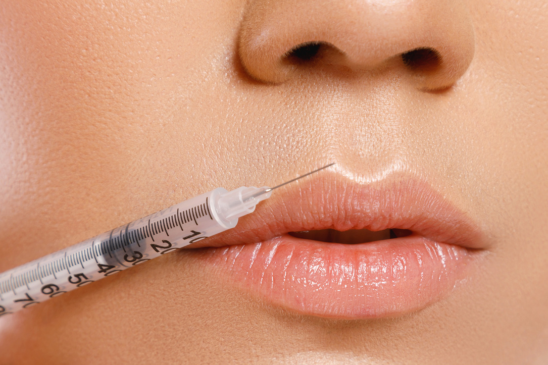 Female lips and syringe with a filler
